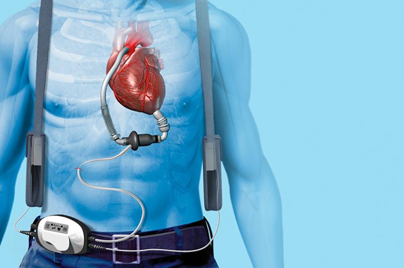 Cardiac Assist Devices Market
