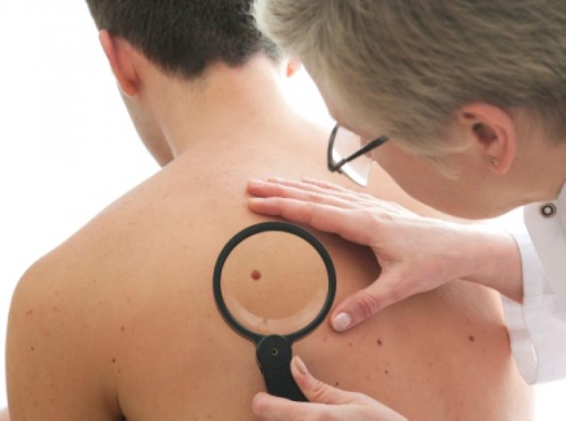 Melanoma Therapeutics Market