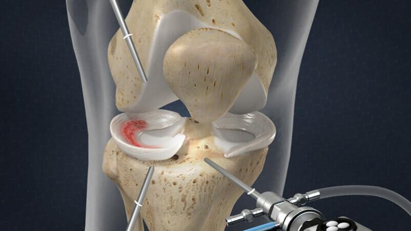 Meniscus Repair Systems 