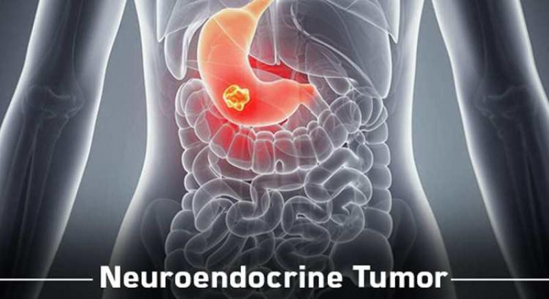 Neuroendocrine Tumours Therapeutics Market