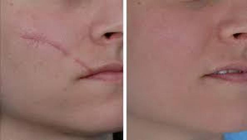 Scar Treatment Market 