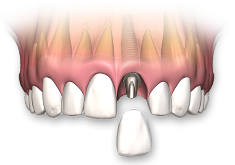 Вставить зубы в чите. Вставить зубы в чите. Акция на протезирование зубов. Вставить зубы в чите. Композитные виниры оттенки.