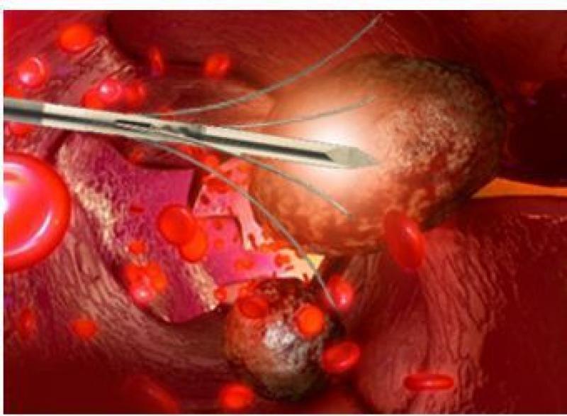 Europe Tumor Ablation Market