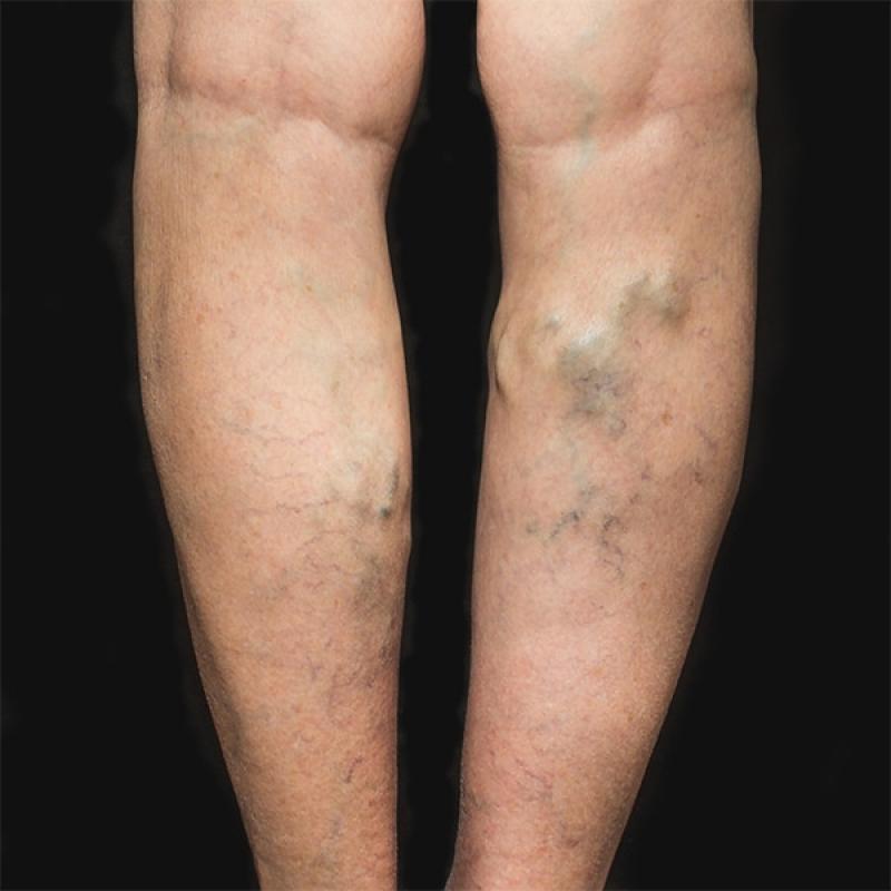 Europe Varicose Vein Treatment Market By Treatment