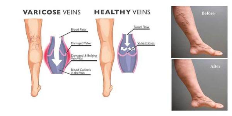 Varicose Veins Treatment Market