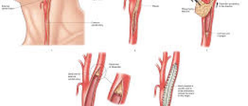 Vascular Patches