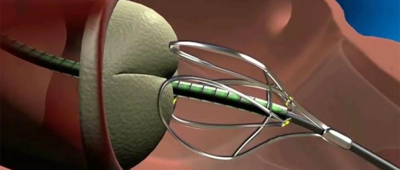 Global Transcatheter Aortic Valve Replacement Report-2016
