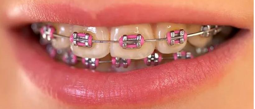 Chipped Teeth Treatment & Repair
