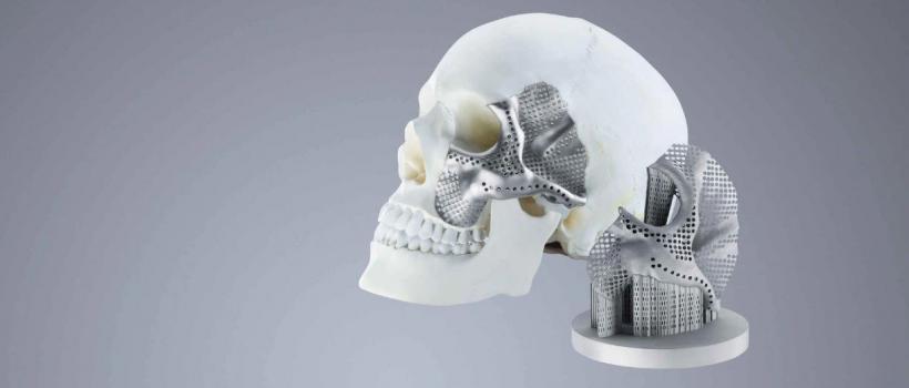 3D Printed Medical Implants Market Share, Restraints, Segments And Regions