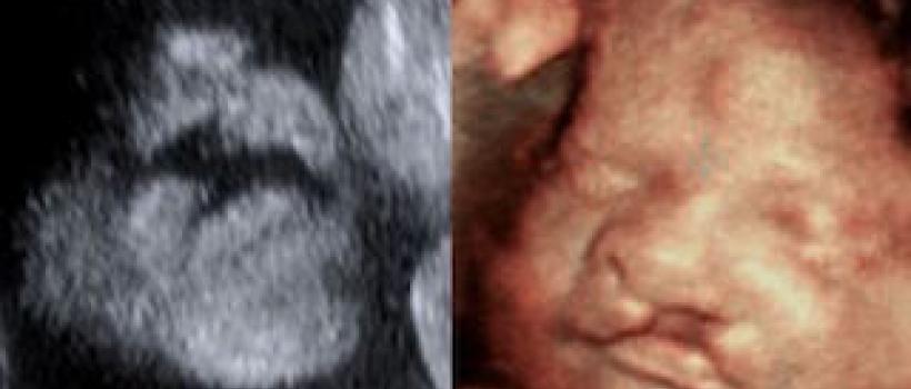 3D Ultrasound Imaging is Estimated to Witness High Growth Owing to Advancement in Ultrasound Technology