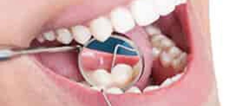 Best Root Canal Treatment 