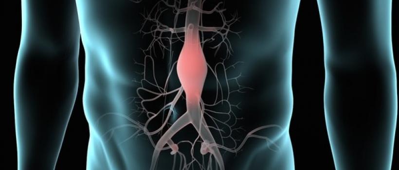  Abdominal Aortic Aneurysm