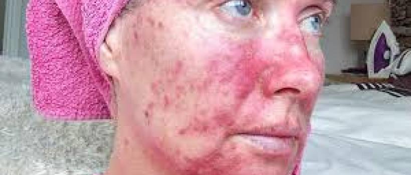 Actinic (Solar) Keratosis Treatment Market