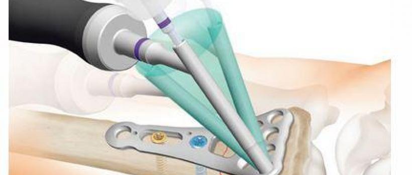 Adjustable Bone Plate 