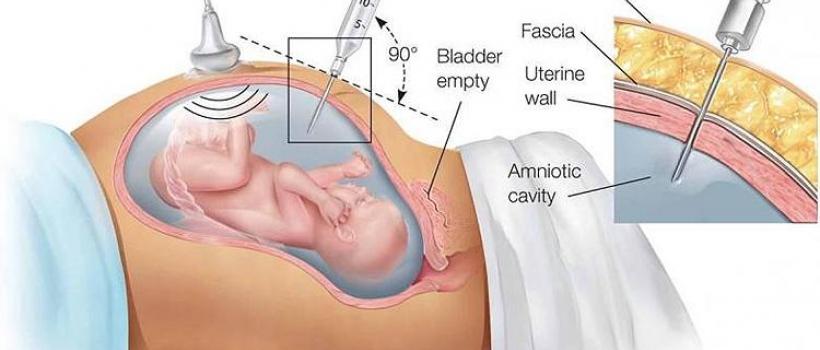 Amniocentesis Needle Market