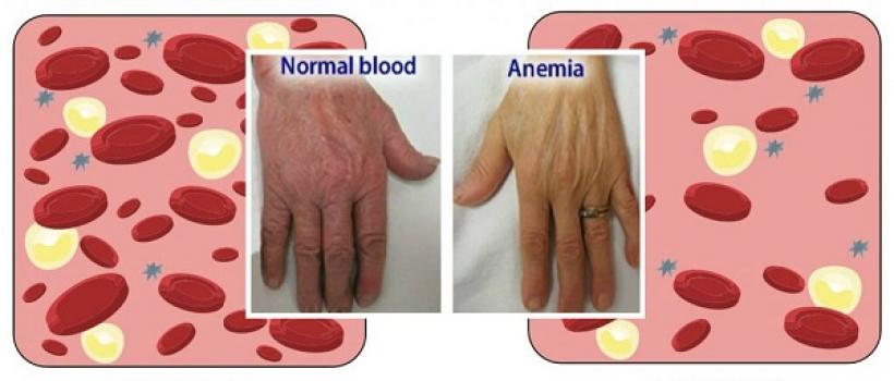Anemia Treatment Drugs Industry