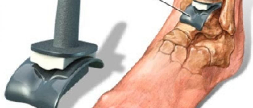 Global Ankle Prosthesis Market Research Reports Forecast 2023