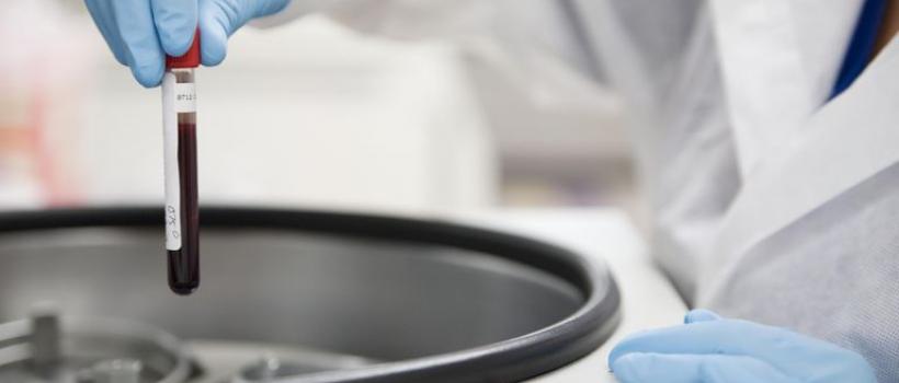 Antinuclear Antibody Test