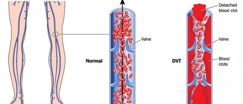 Antithrombin Market