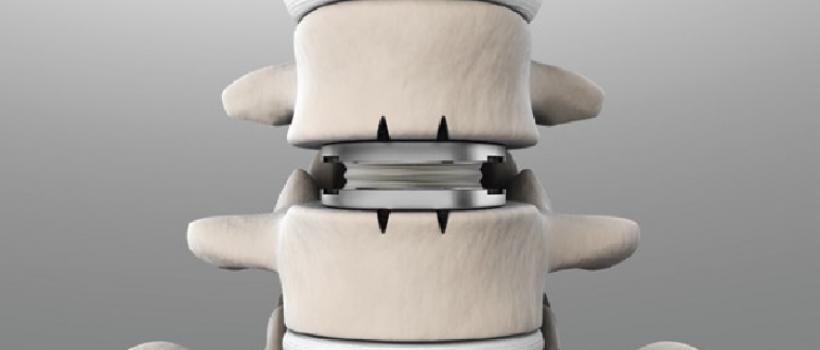 Artificial Disc Industry