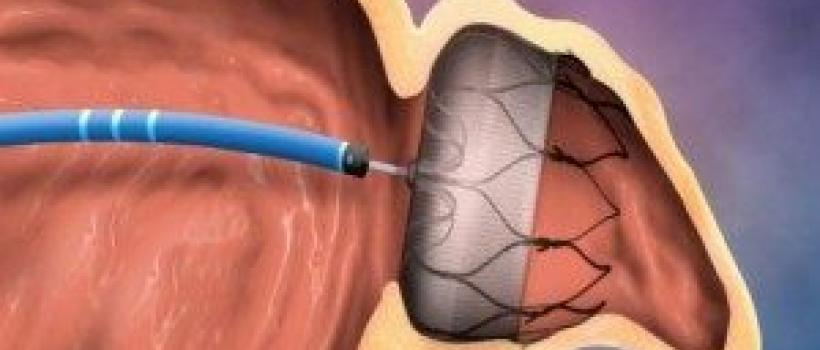Atrial Fibrillation Devices