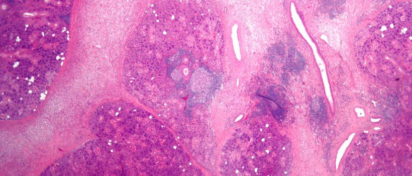 Bacterial Sialadenitis Market