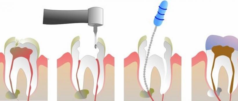 Bioimplants Market Size
