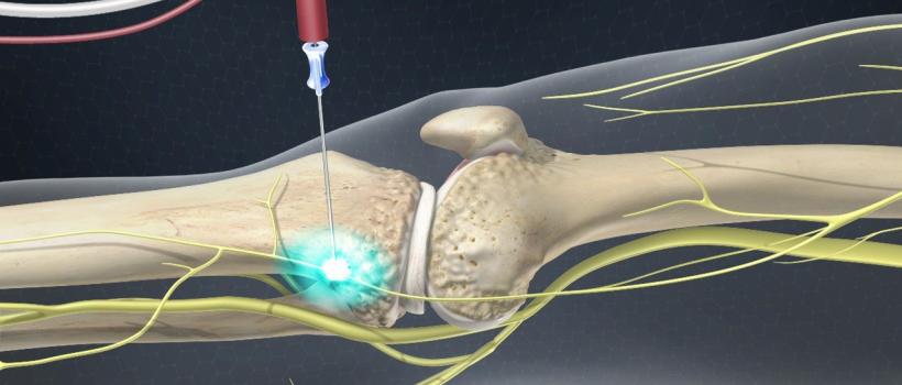 Bone Tumor Ablation Devices Market