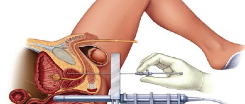 Brachytherapy 