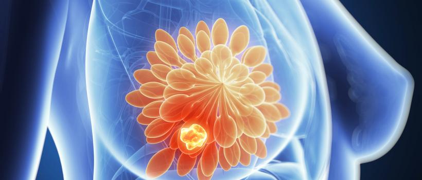 Best Breast Cancer Treatment In Mumbai