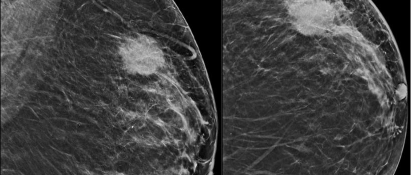 Breast Imaging Market