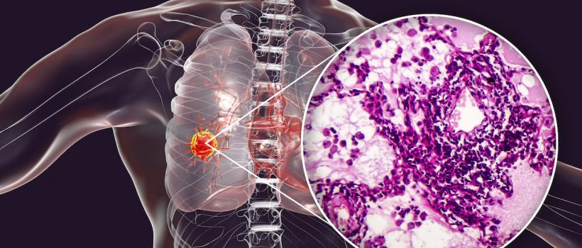 Cancer Biopsy Market