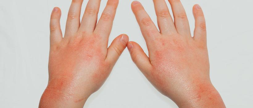 Canine Atopic Dermatitis Treatment