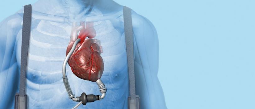 Cardiac Assist Devices