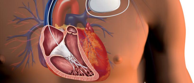 Cardiac Pacemaker