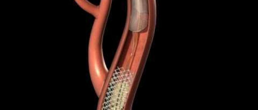 Carotid Stent