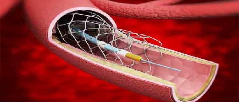 Cerebral Vascular Stent Industry