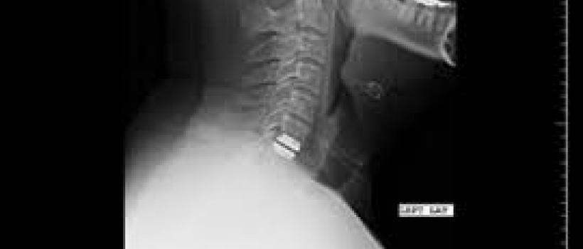 Cervical Disc Prosthesis 