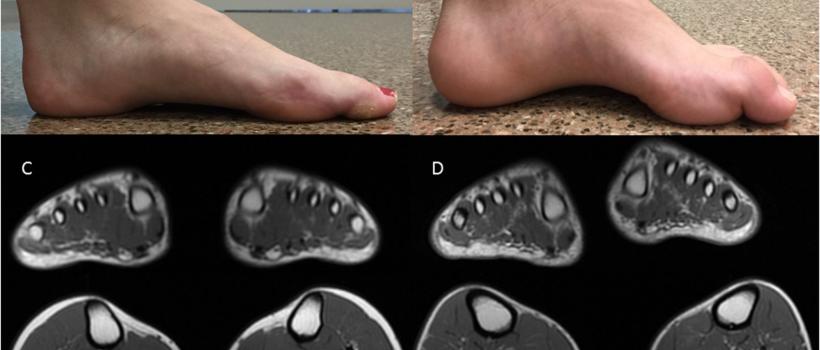 Charcot-Marie-Tooth Disease Market