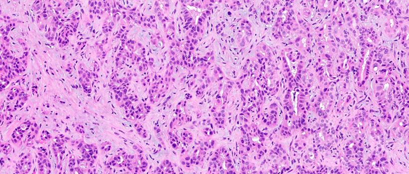 Cholangiocarcinoma Market 