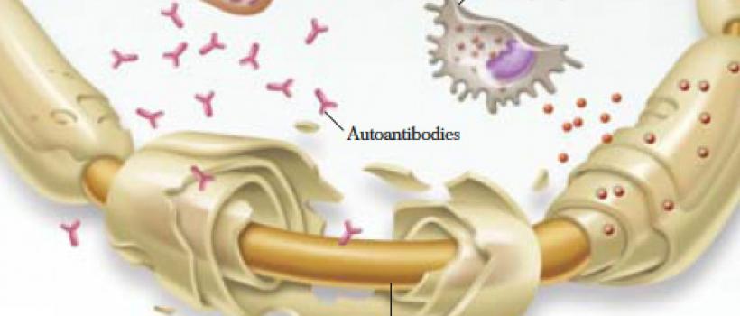 Chronic Inflammatory Demyelinating Polyneuropathy (CIDP) Market