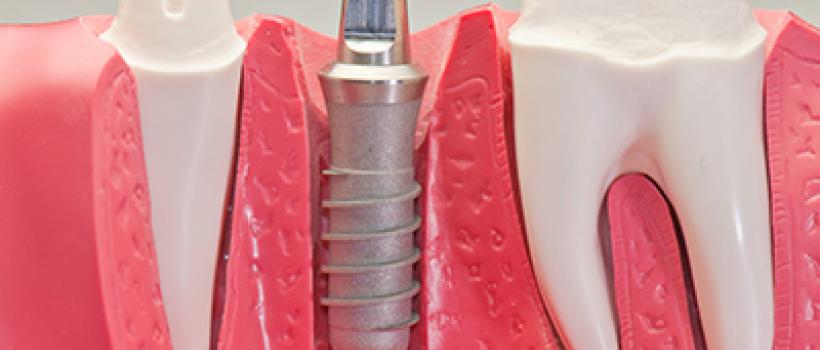 Cosmetic Implant Market