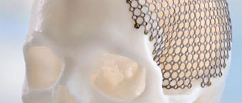 Cranio Maxillofacial Implants Market