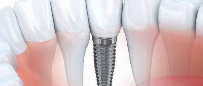 Dental Bone Graft Substitutes Market