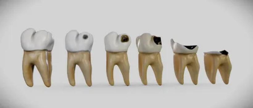 Dental Caries Treatment