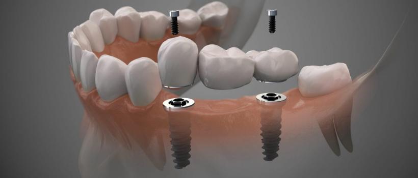 Dental Implants Market