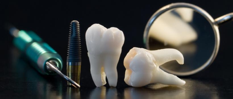 Dental Implants