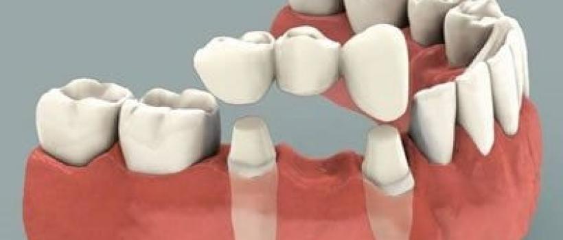 Dental Crown And Bridges Market