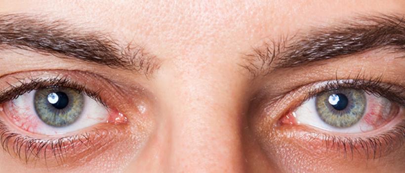 Dry Eye Disease Market