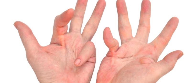 Dupuytrens Disease